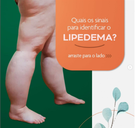 Tratamento Lipedema - Dr. Fábio Kamamoto