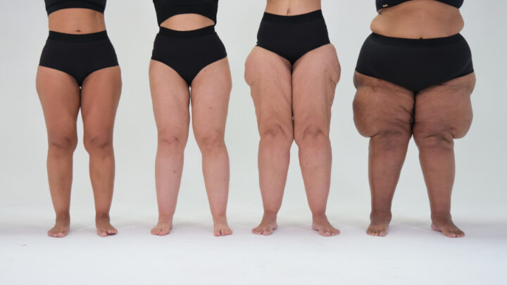 Estudo revela por que pacientes com lipedema têm dificuldade em ganhar massa muscular